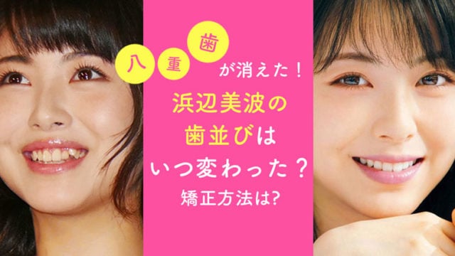 浜辺美波, 歯並び, 八重歯, 矯正, 可愛い, 君の膵臓を食べたい